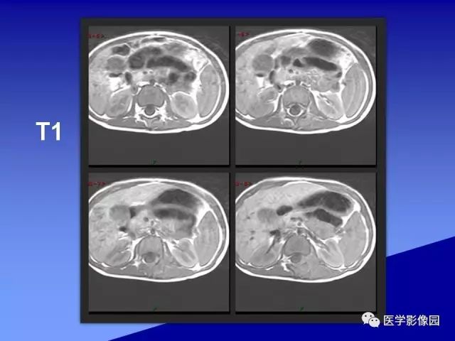 【病例】腰椎嗜酸性肉芽肿1例X线CT及MR影像表现