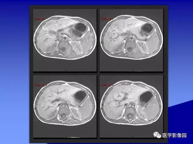 【病例】腰椎嗜酸性肉芽肿1例X线CT及MR影像表现