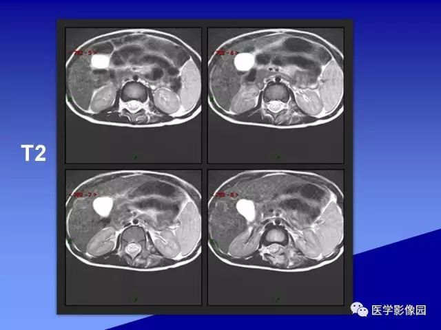 【病例】腰椎嗜酸性肉芽肿1例X线CT及MR影像表现