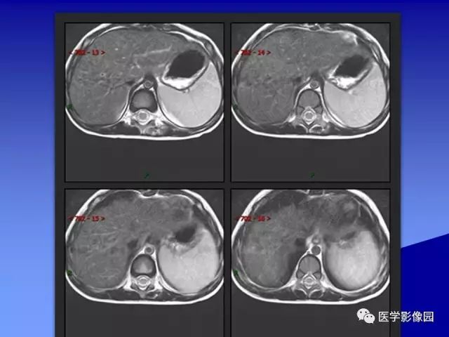 【病例】腰椎嗜酸性肉芽肿1例X线CT及MR影像表现