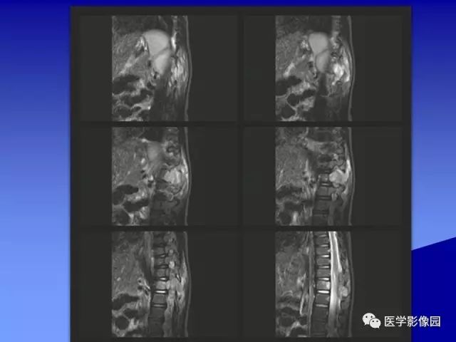【病例】腰椎嗜酸性肉芽肿1例X线CT及MR影像表现