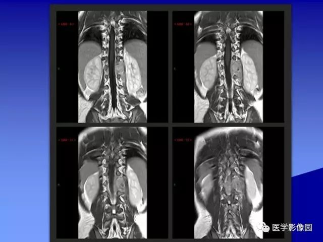 【病例】腰椎嗜酸性肉芽肿1例X线CT及MR影像表现