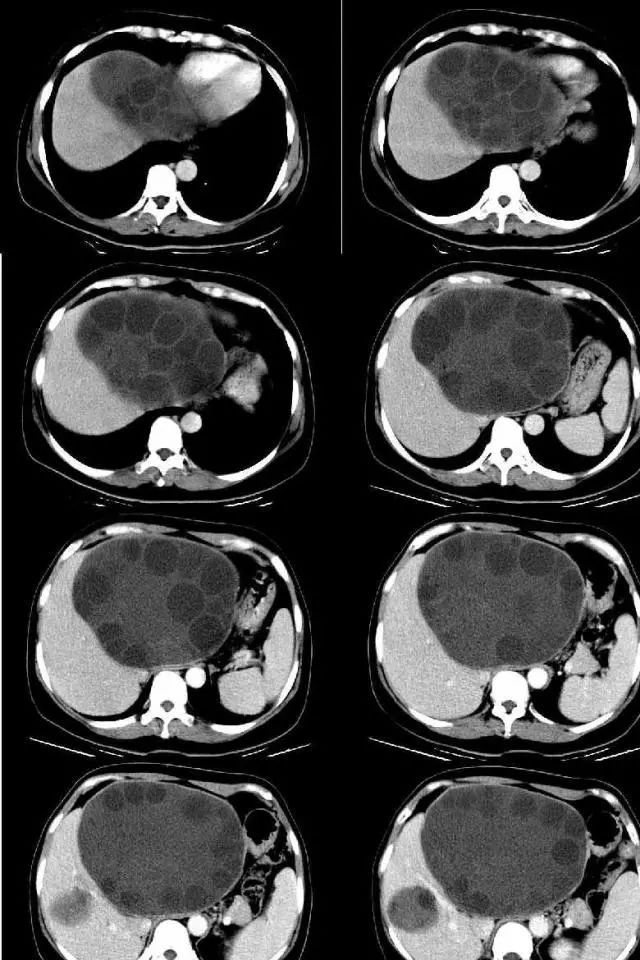 【病例】肝包虫病1例CT 【病例】肝包虫病1例CT