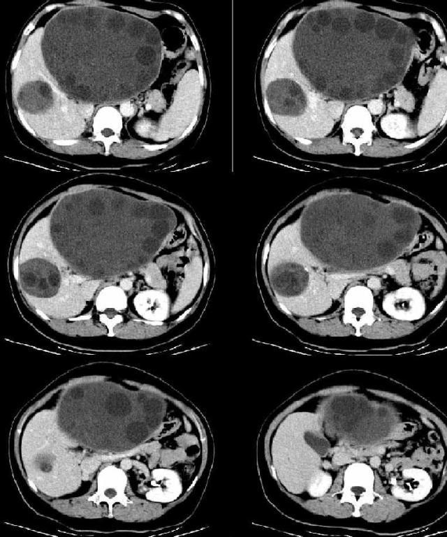 【病例】肝包虫病1例CT 【病例】肝包虫病1例CT