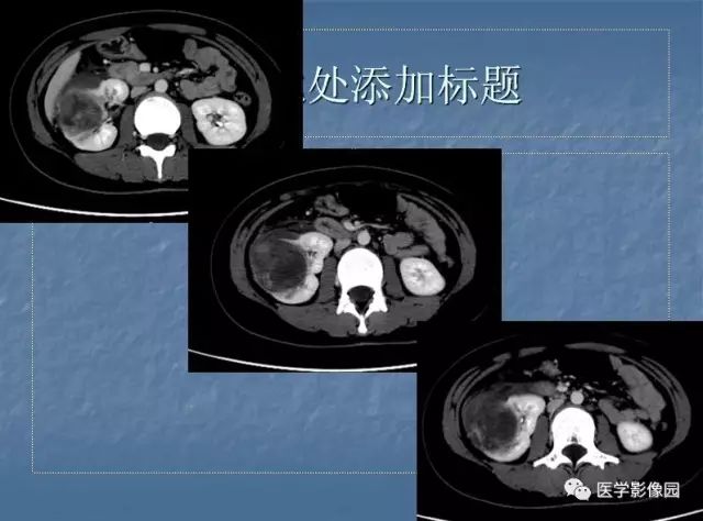 【病例】右肾母细胞瘤1例CT影像表现