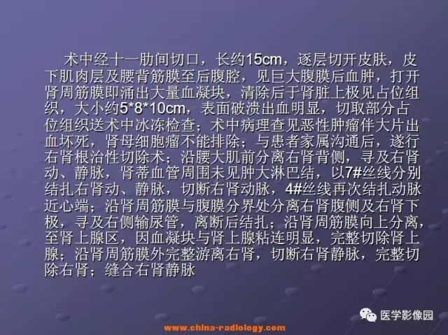 【病例】右肾母细胞瘤1例CT影像表现