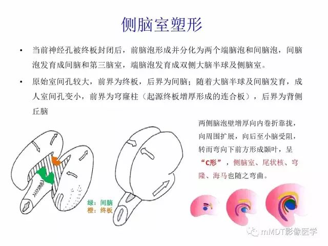 【PPT】侧脑室发育及常见肿瘤与肿瘤样病变的鉴别诊断