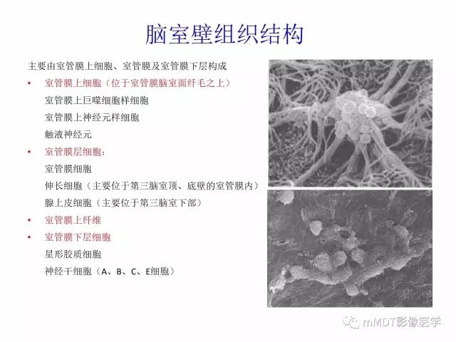 【PPT】侧脑室发育及常见肿瘤与肿瘤样病变的鉴别诊断