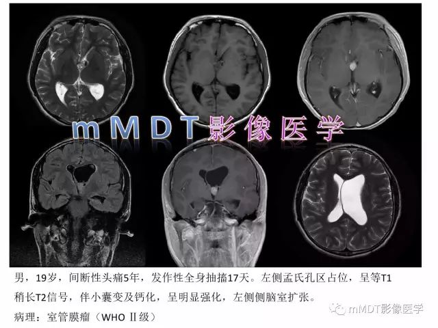 【PPT】侧脑室发育及常见肿瘤与肿瘤样病变的鉴别诊断