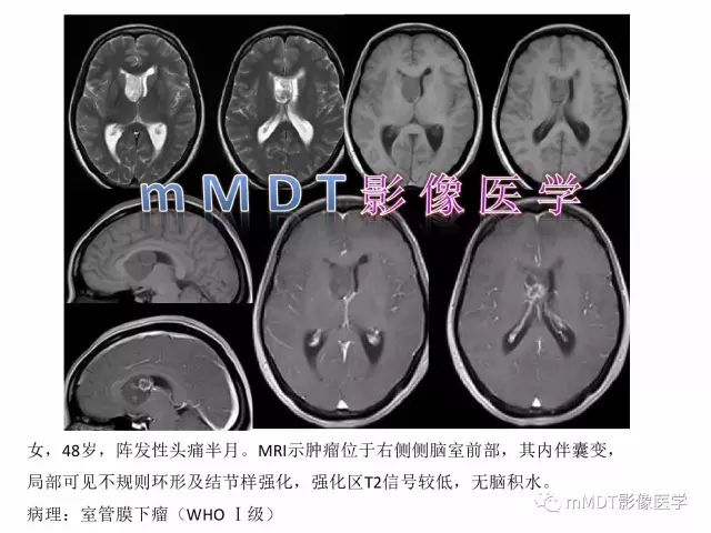 【PPT】侧脑室发育及常见肿瘤与肿瘤样病变的鉴别诊断