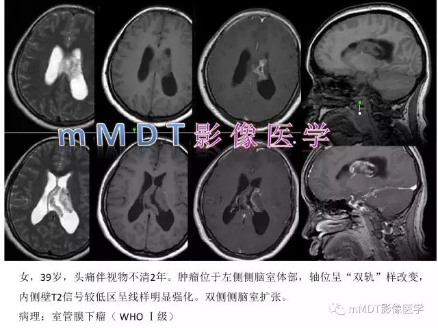 【PPT】侧脑室发育及常见肿瘤与肿瘤样病变的鉴别诊断
