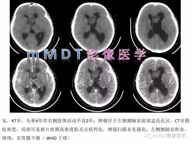【PPT】侧脑室发育及常见肿瘤与肿瘤样病变的鉴别诊断