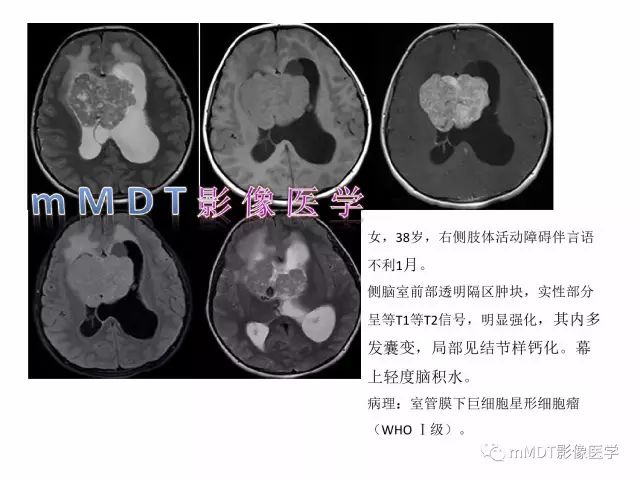 【PPT】侧脑室发育及常见肿瘤与肿瘤样病变的鉴别诊断