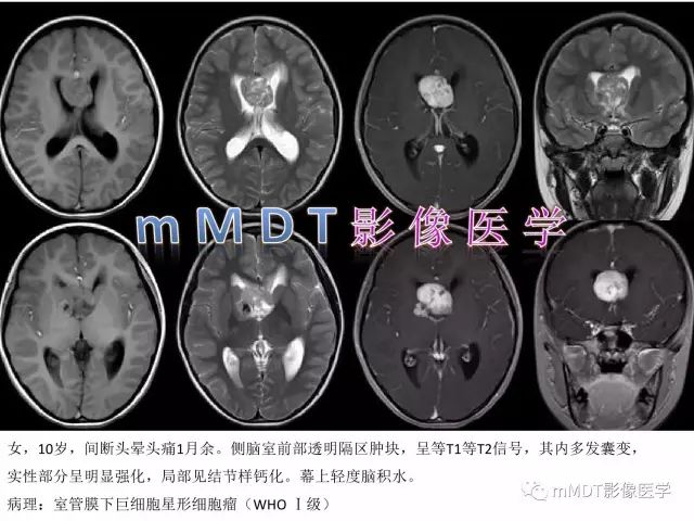 【PPT】侧脑室发育及常见肿瘤与肿瘤样病变的鉴别诊断