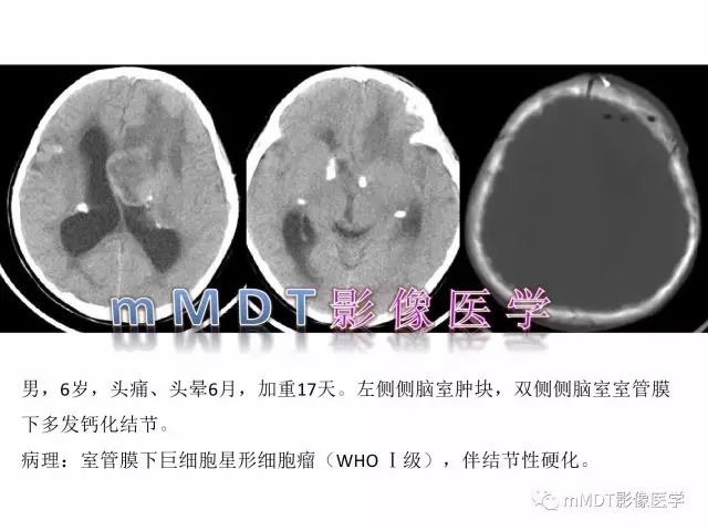 【PPT】侧脑室发育及常见肿瘤与肿瘤样病变的鉴别诊断