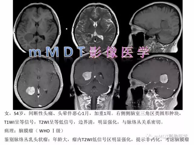 【PPT】侧脑室发育及常见肿瘤与肿瘤样病变的鉴别诊断