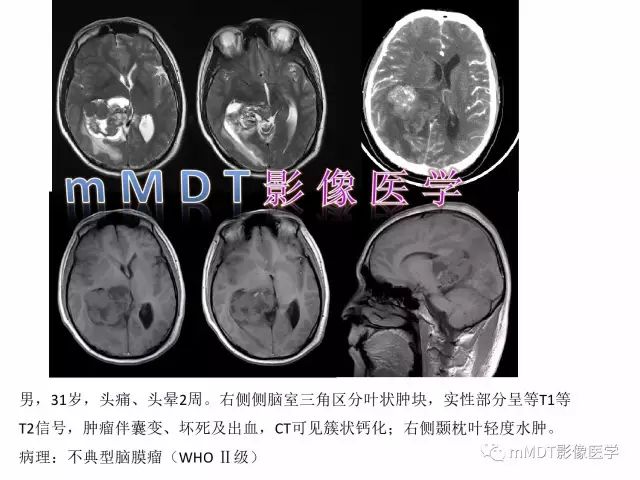 【PPT】侧脑室发育及常见肿瘤与肿瘤样病变的鉴别诊断