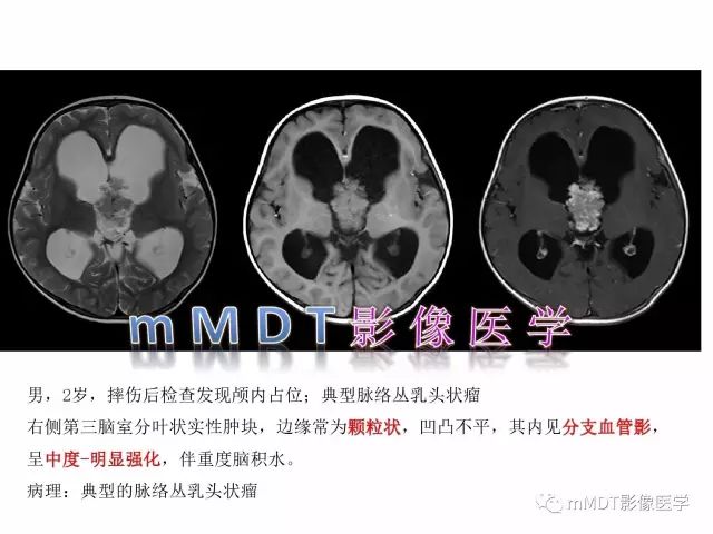 【PPT】侧脑室发育及常见肿瘤与肿瘤样病变的鉴别诊断
