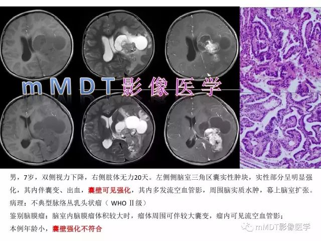 【PPT】侧脑室发育及常见肿瘤与肿瘤样病变的鉴别诊断