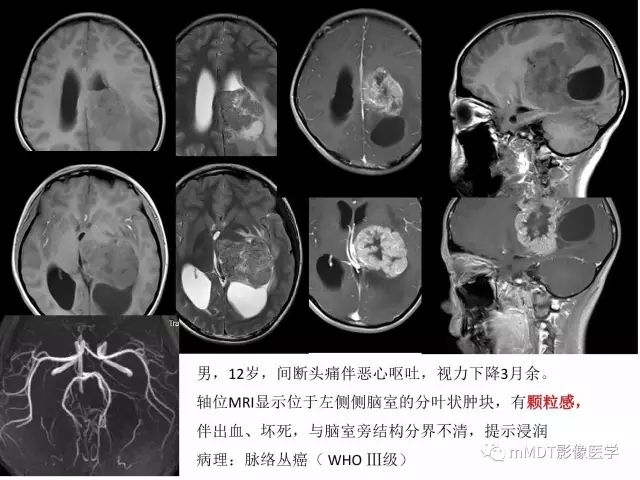 【PPT】侧脑室发育及常见肿瘤与肿瘤样病变的鉴别诊断