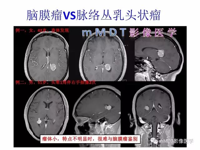 【PPT】侧脑室发育及常见肿瘤与肿瘤样病变的鉴别诊断