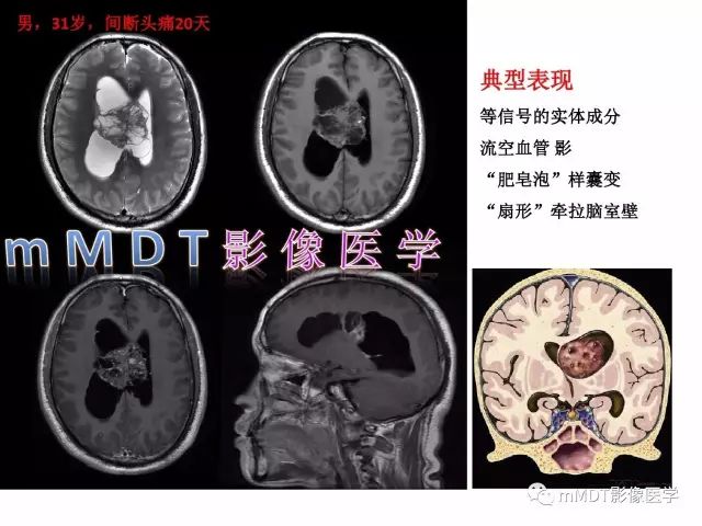 【PPT】侧脑室发育及常见肿瘤与肿瘤样病变的鉴别诊断