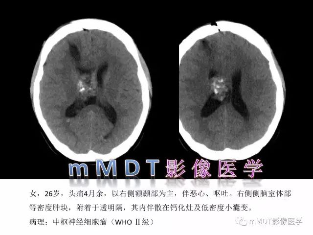 【PPT】侧脑室发育及常见肿瘤与肿瘤样病变的鉴别诊断