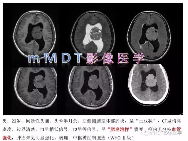 【PPT】侧脑室发育及常见肿瘤与肿瘤样病变的鉴别诊断