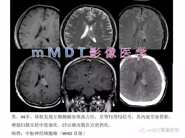 【PPT】侧脑室发育及常见肿瘤与肿瘤样病变的鉴别诊断