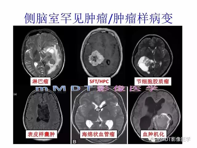 【PPT】侧脑室发育及常见肿瘤与肿瘤样病变的鉴别诊断