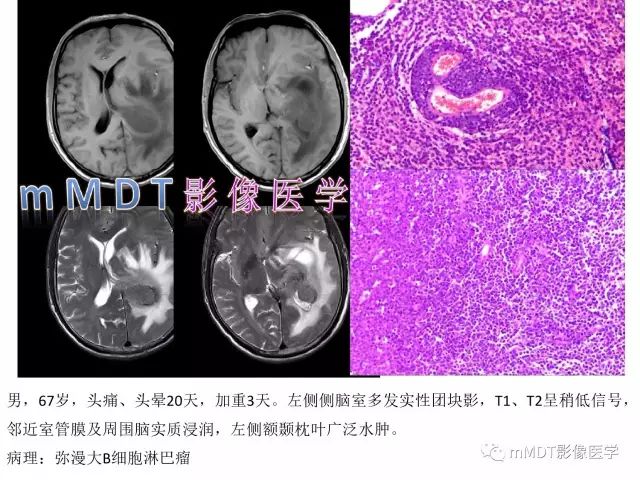 【PPT】侧脑室发育及常见肿瘤与肿瘤样病变的鉴别诊断