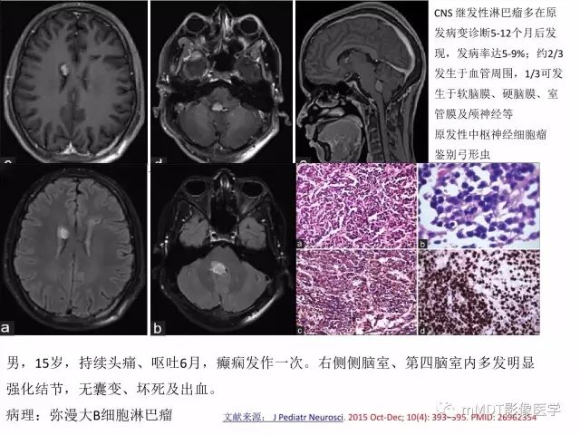 【PPT】侧脑室发育及常见肿瘤与肿瘤样病变的鉴别诊断