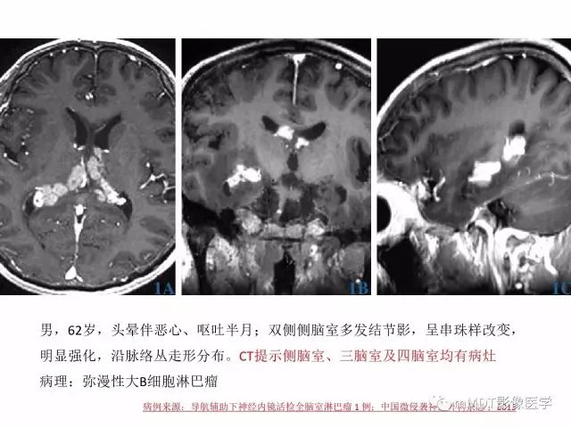 【PPT】侧脑室发育及常见肿瘤与肿瘤样病变的鉴别诊断