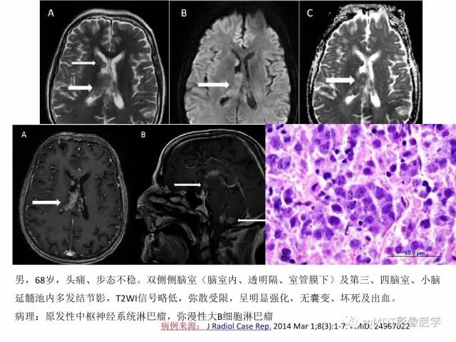 【PPT】侧脑室发育及常见肿瘤与肿瘤样病变的鉴别诊断