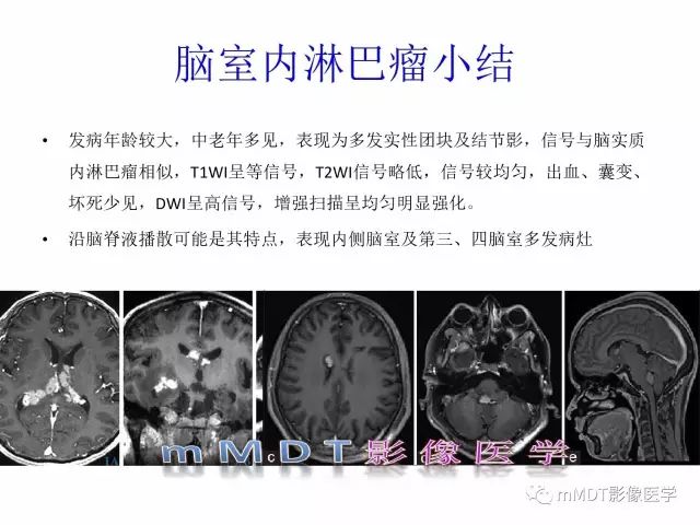 【PPT】侧脑室发育及常见肿瘤与肿瘤样病变的鉴别诊断