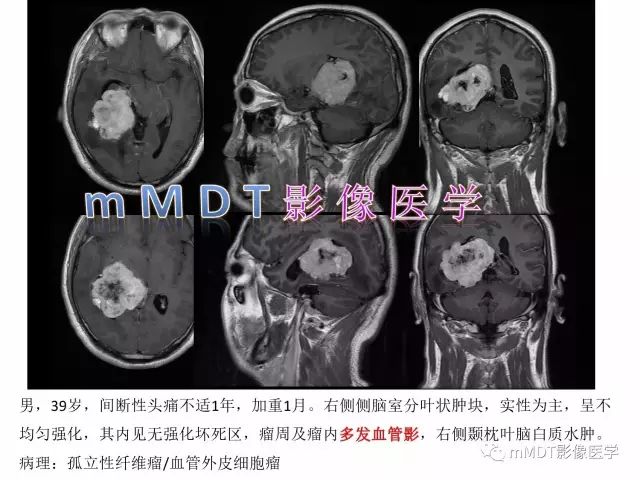 【PPT】侧脑室发育及常见肿瘤与肿瘤样病变的鉴别诊断