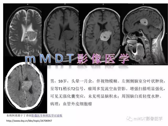 【PPT】侧脑室发育及常见肿瘤与肿瘤样病变的鉴别诊断