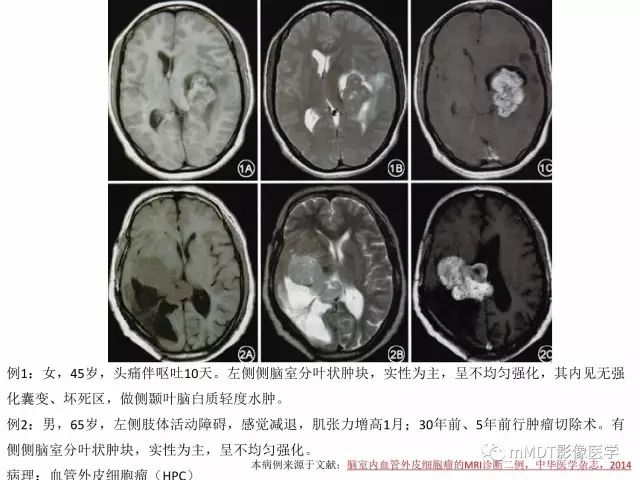 【PPT】侧脑室发育及常见肿瘤与肿瘤样病变的鉴别诊断