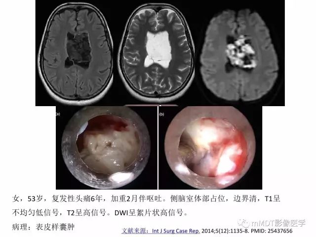【PPT】侧脑室发育及常见肿瘤与肿瘤样病变的鉴别诊断