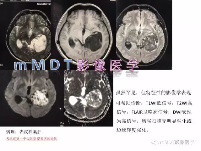 【PPT】侧脑室发育及常见肿瘤与肿瘤样病变的鉴别诊断