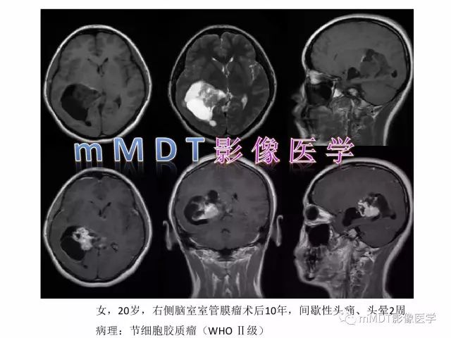 【PPT】侧脑室发育及常见肿瘤与肿瘤样病变的鉴别诊断