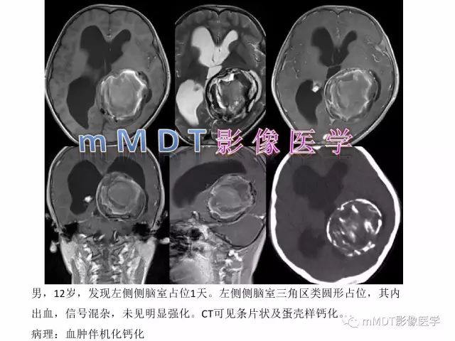 【PPT】侧脑室发育及常见肿瘤与肿瘤样病变的鉴别诊断