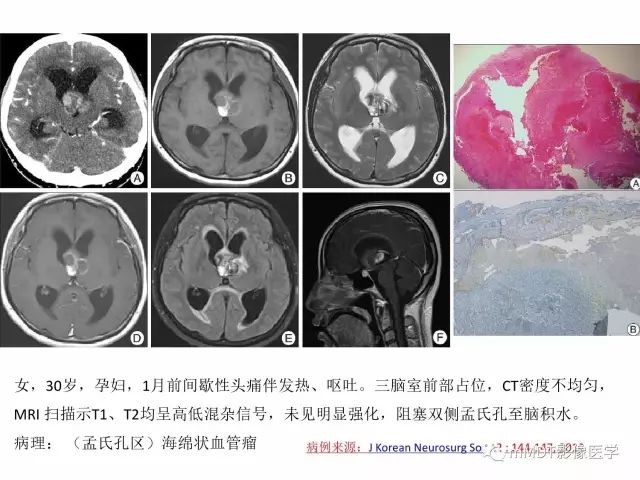 【PPT】侧脑室发育及常见肿瘤与肿瘤样病变的鉴别诊断
