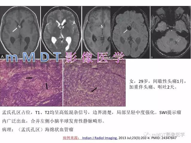 【PPT】侧脑室发育及常见肿瘤与肿瘤样病变的鉴别诊断