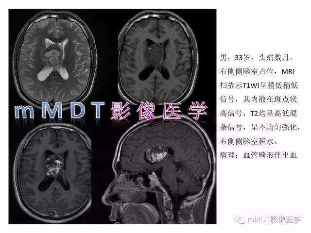 【PPT】侧脑室发育及常见肿瘤与肿瘤样病变的鉴别诊断