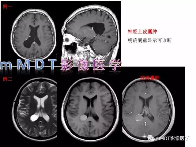 【PPT】侧脑室发育及常见肿瘤与肿瘤样病变的鉴别诊断