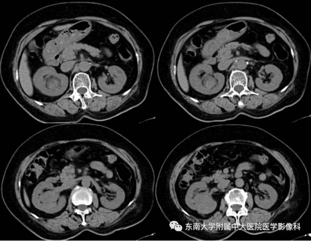 【病例】肾癌1例CT影像表现