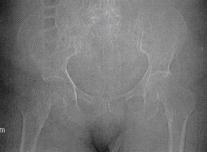 【病例】右髋关节滑膜骨软骨瘤病1例 【病例】右髋关节滑膜骨软骨瘤病1例
