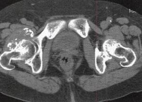 【病例】右髋关节滑膜骨软骨瘤病1例 【病例】右髋关节滑膜骨软骨瘤病1例