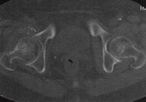【病例】右髋关节滑膜骨软骨瘤病1例 【病例】右髋关节滑膜骨软骨瘤病1例